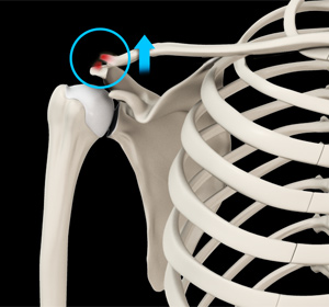 AC Joint Dislocation