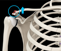 AC Joint Dislocation