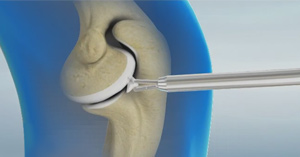 Arthroscopic Debridement