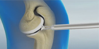 Arthroscopic Debridement