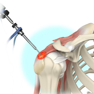 Arthroscopic Decompression and Calcium Excision