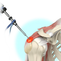 Arthroscopic Decompression and Calcium Excision