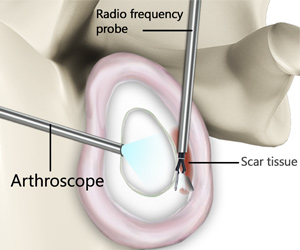 Arthroscopic Release