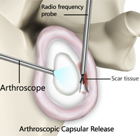 Arthroscopic Release