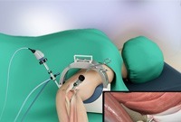 Arthroscopic Tennis Elbow Release