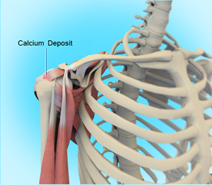 Calcific Tendinitis