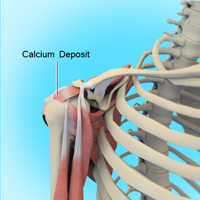 Calcific Tendinitis