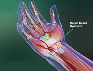 Carpal Tunnel Syndrome