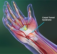 Carpal Tunnel Syndrome