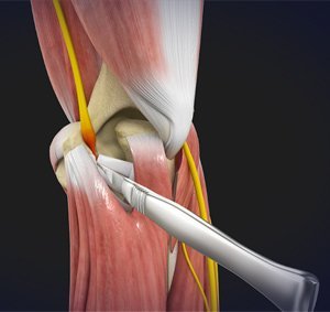 Liberação do Túnel Cubital Cirurgia