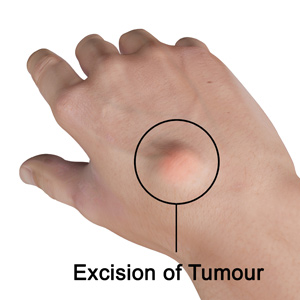 Excision of Tumour