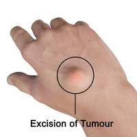 Excision of Tumour