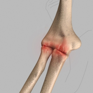 Elbow Arthritis