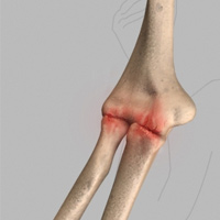 Elbow Arthritis