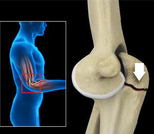 Elbow Fractures