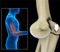 Elbow Fractures