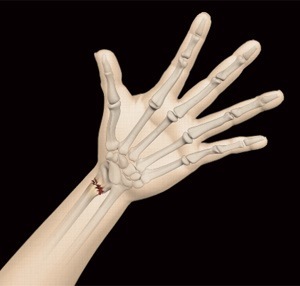 How Hand Fractures are Diagnosed and Treated