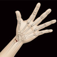 Hand Fractures