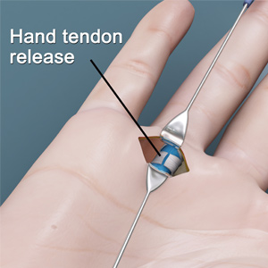 Hand Tendon Release