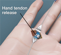 Hand Tendon Release