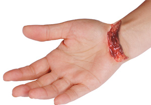 Laceration Hand