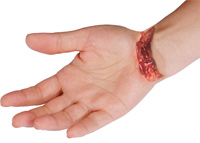 Laceration Hand