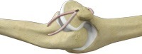 Ligament Reconstruction