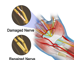 Microsurgery Nerve Repair/Nerve Grafting