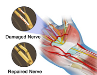 Microsurgery Nerve Repair/Nerve Grafting
