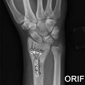 Arthroscopic Debridement