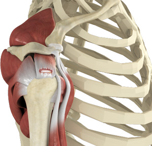 Rotator Cuff Tear