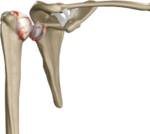 Shoulder Arthritis