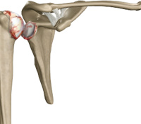 Shoulder Arthritis