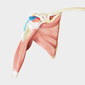 Shoulder Bursitis