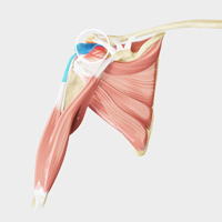 Shoulder Bursitis