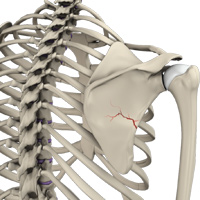 Shoulder Fracture