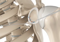 Arthroscopic Stabilization of Shoulder