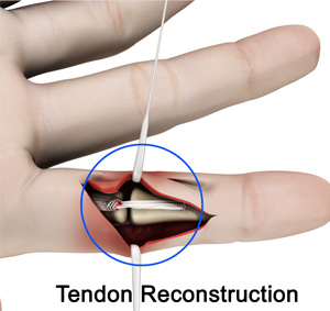 Tendon Reconstruction