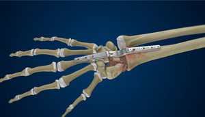 Total Wrist Arthrodesis