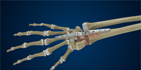 Total Wrist Arthrodesis