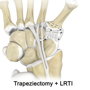 Trapeziectomy + LRTI