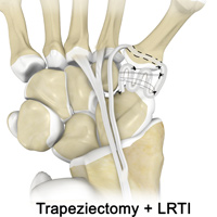 Trapeziectomy + LRTI