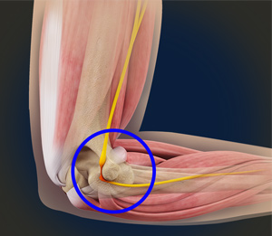 Ulnar Nerve Transposition