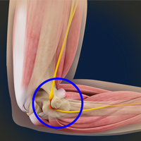 Ulnar Nerve Transposition