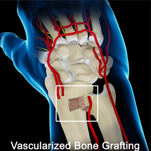 Vascularized Bone Grafting