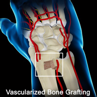 Vascularized Bone Grafting