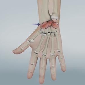 Arthritis of the Wrist