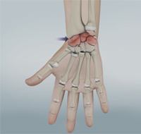 Arthritis of the Wrist