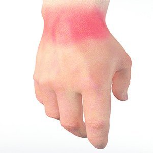 Wrist Pain